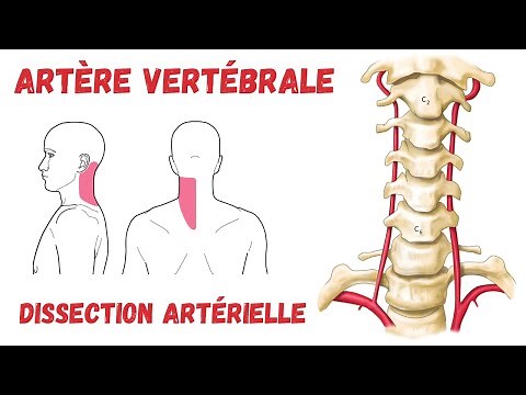 Artère Vertébrale - Anatomie Descriptive et Dissection artérielle (DAC)