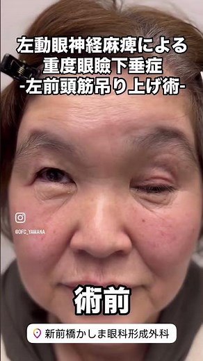 【術前&術後】左顔面神経麻痺による重症眼瞼下垂-前頭筋吊り上げ術-