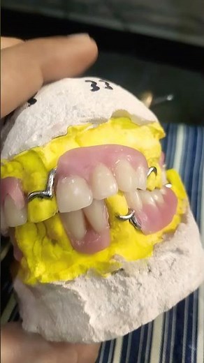 Upper Lower Removable Cost Partial Denture Ready For Flasking 😁😁😁#rpddentalprocedure#viralvideo