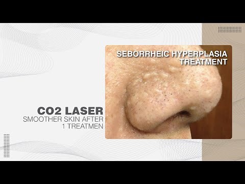 Seborrheic Hyperplasia Treatment - Bella Clinic Treatment