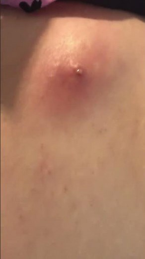Huge boil popped!