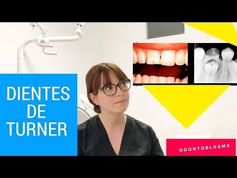 Turner's teeth