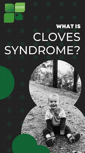 2.3K views · 14 shares | What is CLOVES Syndrome? CLOVES is an...