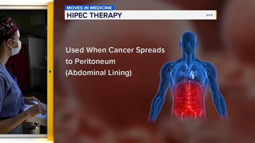 Heated chemotherapy can extend survival when cancer spread to abdomen