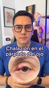 Chalazión en el párpado del ojo no es lo mismo que un orzuelo. #medicina | Dr. William Guerrero