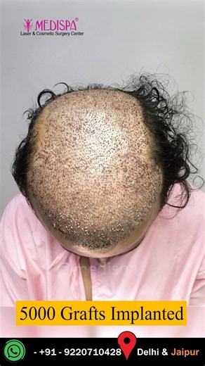 5000 Grafts | Grade 6 | Hair Transplant Results with Advanced Medispa Technique