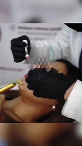 Natural Lip augmentation