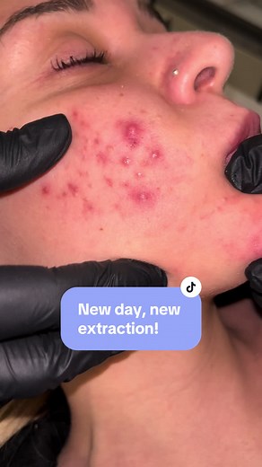 Another day, another extraction! 🤩 #beautytok #puntineri #fyp #blackhead #blackheadsremoval #asmrtiktoks #beautyasmr