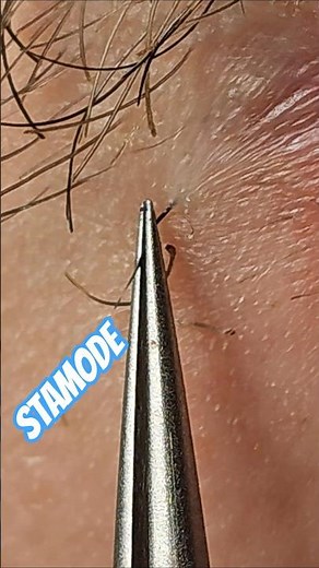 Hair Removal — Close-Up Mustache Tweezing 😬 #facialhair #tweezing #plucking