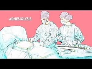 Adhesiolysis; surgical procedure performed to remove or separate adhesions, bands of scar tissue