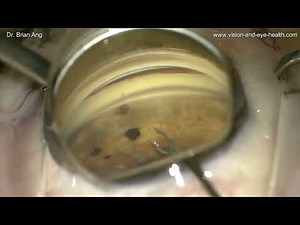 CyPass micro-stent removal - Dr Brian Ang, Glaucoma Specialist & Cataract Surgeon