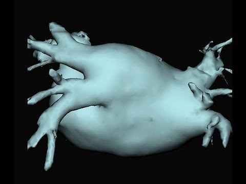 Watch a Live Case of AFib Ablation: How to Fix Long-Standing Persistent AFib