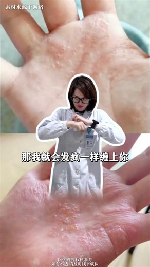 Dyshidrosis Flare-Up? Uncover These Must-Know Secrets