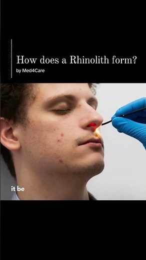 How Does a Rhinolith Form