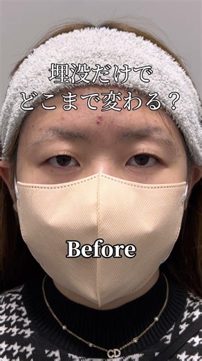 【目周り整形】埋没でどこまで変わる？#shorts