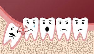 Difference between Dental Implants and Dental Transplants