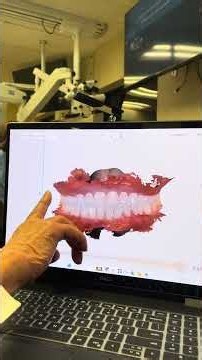 Did you know you can treat receding gums on both the upper and lower arch in just one appointment? 😲