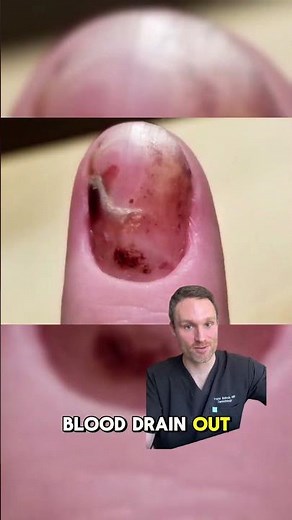 Watch this subungual hematoma!