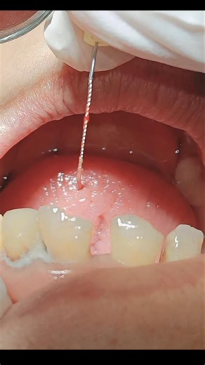 pulp tissue removal #dentist #dental