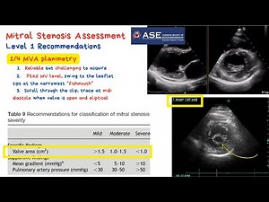 MVA planimetry - Mitral Stenosis severity assessment with example - echo review