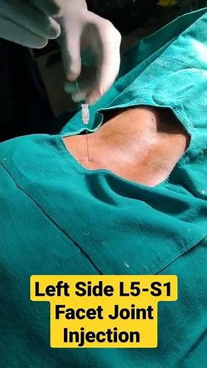 Left Side L5-S1 Facet Joint Injection under CArm..Dr Sai Chandra MBBS DNB Ortho