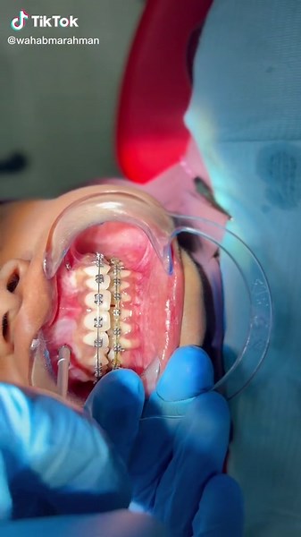 MiNi Screw placement in orthodontics #orthodontics #maldives #male #braces #TADs #smile @mediflexmv