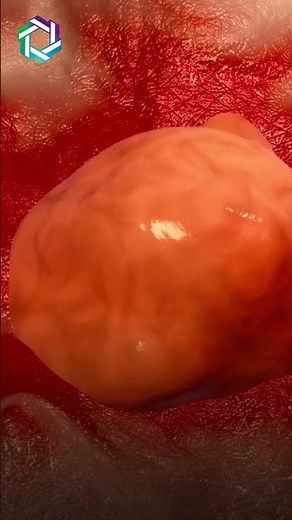 How does Cancer Spreads? | A Closer Look at Cancer's Spread Mechanisms | Dr Vivek Sukumar