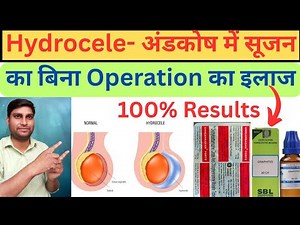 What Is Hydrocele? Causes,Symptoms & Treatment🔥