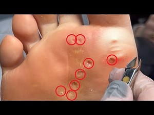 8 CALLUSES removal in 2 minutes