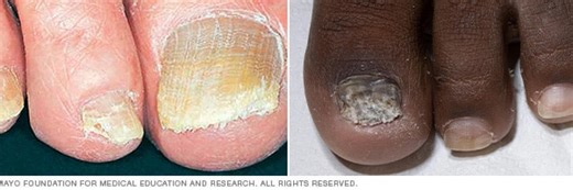 Toenail Fungus Treatment