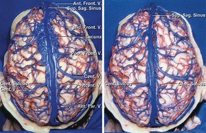 Parasagittal Craniotomy | Cohen Collection | Volumes | The Neurosurgical Atlas