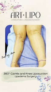 Heavy legs no more! 🙌 360° Cankle & Knee Liposuction by Dr. George Kardashian is more than a transformation—it’s freedom you can feel instantly! 💪 💫 Immediate results, minimal downtime, and a new level of confidence. These legs got the ultimate makeover—yours can too! Ready for your transformation? 🤩 Call us today 📞 1 (813) 886-9090 or click the link in our bio to schedule a complimentary virtual consultation! Patients are welcome worldwide! 🌎 📍 Tampa, Florida | ArtLipo Liposuction & Lipe