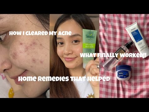 My Honest Acne Story | Skincare Routine| Home Remedies & Products.