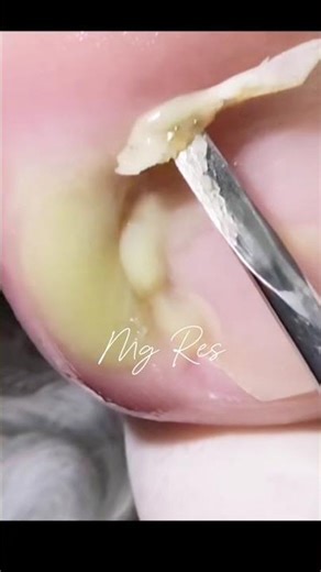 removal ingrown fingernail