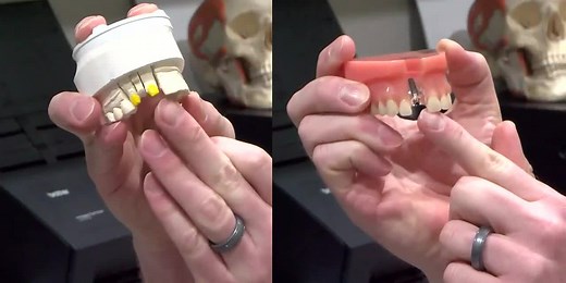 HEALTHWATCH: Implants vs. Bridges