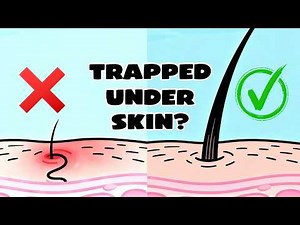 How Do Ingrown Hairs Form? (And Why Some Grow So Long)