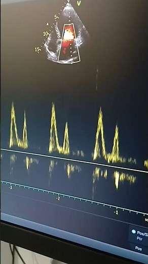 Dilated LA LV with mild MR with grade 2 diastolic dysfunction with poor EF#heart valve leak#heart