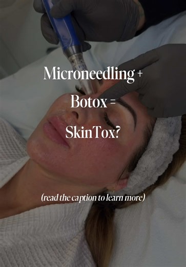 Microneedling Botox: skin-focused instead of muscle-focused. Often called SkinTox, this treatment combines the collagen stimulation of microneedling with micro-dosed Botox placed superficially into the skin. The result isn’t a frozen look. It’s refined, polished, healthier-looking skin. By delivering tiny amounts of Botox into the superficial dermis, we can help: • Minimize the appearance of enlarged pores • Smooth crepey or orange-peel texture • Soften fine etched lines that don’t fully respond