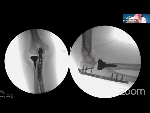 Radial Head Replacement