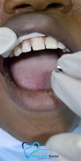 Exploring Silver Teeth Transformations in Dental TikTok