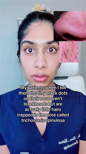 Trichostasis spinulosa is a fairly common condition that is often misdiagnosed as open comedones or sebaceous filaments. It consists of tiny trapped vellus (baby) hairs in the pores and is common in Asian skin (I have this). Pore strips can actually help remove these. So can tweezing, waxing or laser hair removal. #trichostasisspinulosa #nosepores #fyp