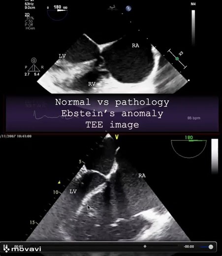 Normal vs pathology Ebstein’s anomaly TEE image