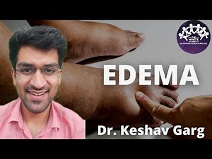 EDEMA