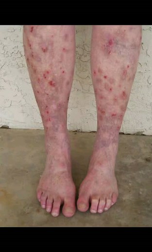 What does MORGELLONS DISEASE look like and how is it treated? Medically reviewed by Avi Varma, MD, MPH, AAHIVS, FAAFP — By Jamie Eske — Updated on Jan 4, 2022 Morgellons disease is a rare condition. Its symptoms include slow-healing skin lesions and fibers underneath or projecting from the skin. People with this disease also report feeling crawling, stinging, or biting sensations in their skin. Morgellons disease remains a controversial topic among researchers and healthcare professionals, as th