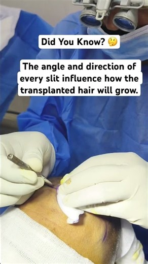 Slit Making in Hair Transplant | The Secret to a Natural Hairline | FUE Procedure#shorts#youtube