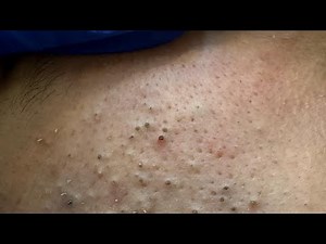 The Ultimate Pimple Treatment: Proven Remedies For Clear Skin