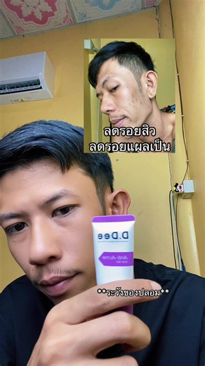 วิธีล้างหน้าให้สะอาดและทาเจลลดรอยสิวประจำวัน
