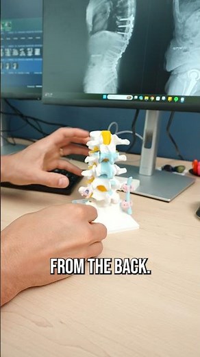 TLIF (Transforaminal Lumbar Interbody Fusion) Spacer