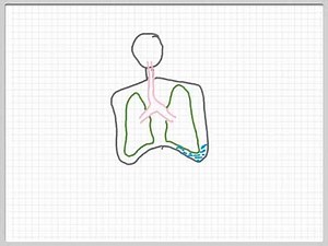 PLEURAL EFFUSION & how doctors treat it with Thoracentesis