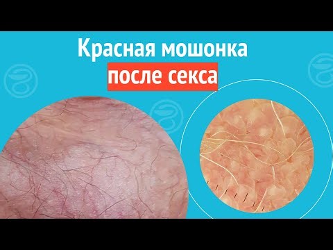 😧 Red scrotum after sex. Case report #1378
